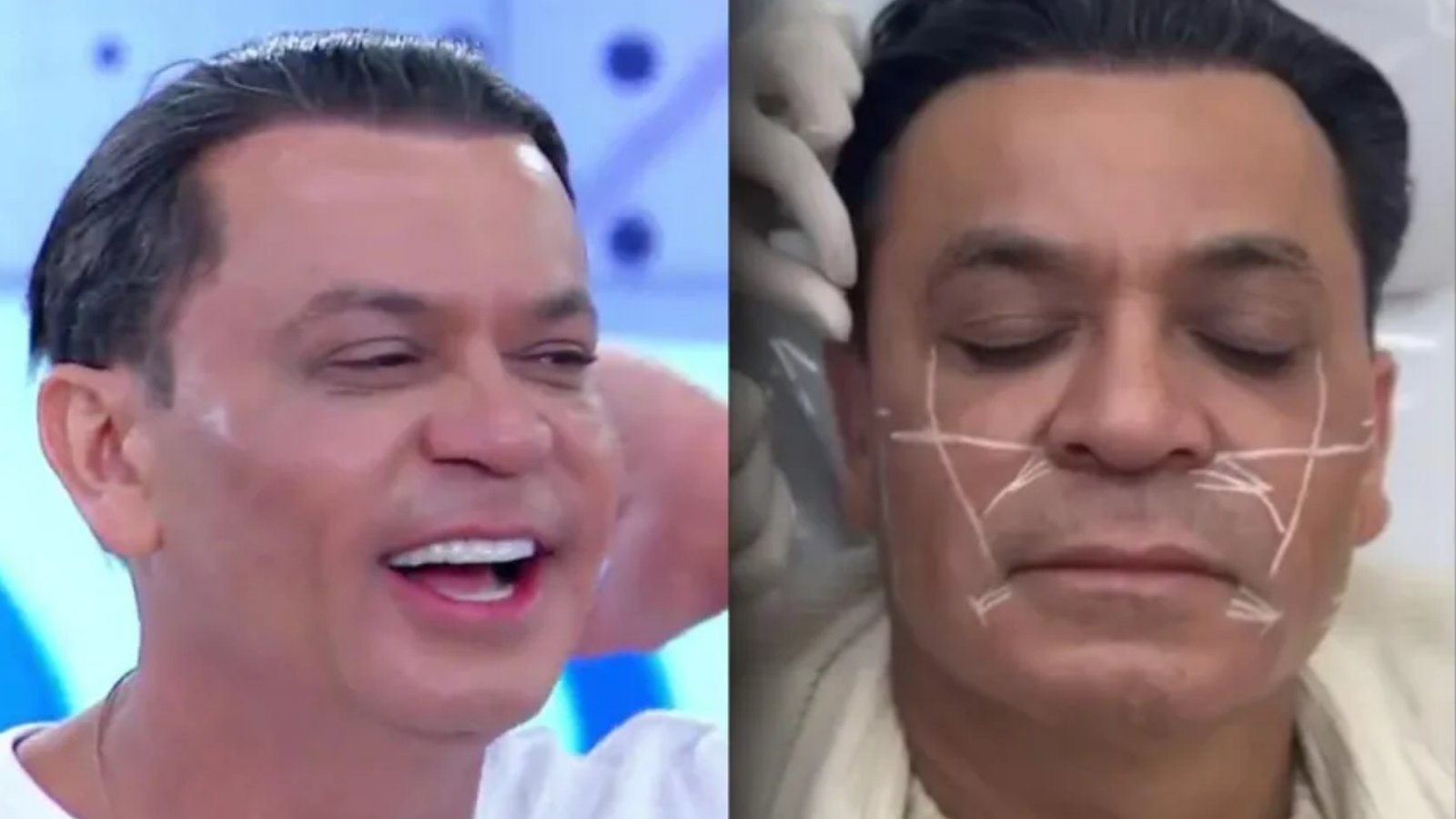 Frank Aguiar rejuvenesce com nova harmonização facial